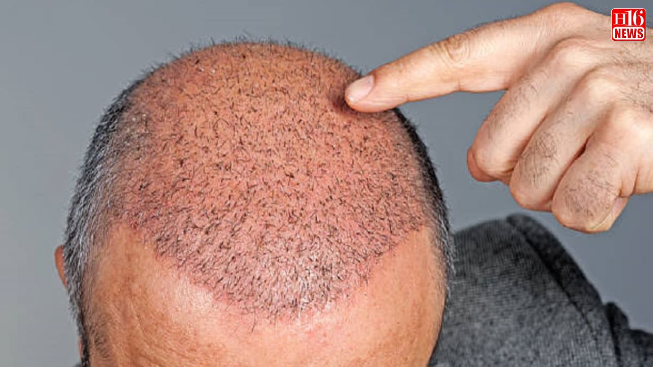 Hair Transplant Can Cure Baldness But Can Also Prove Fatal; KGMU Plastic Surgeon Explains How